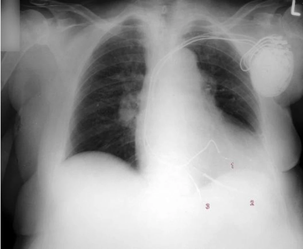 RTG-snímek (předozadní) po implantaci.
