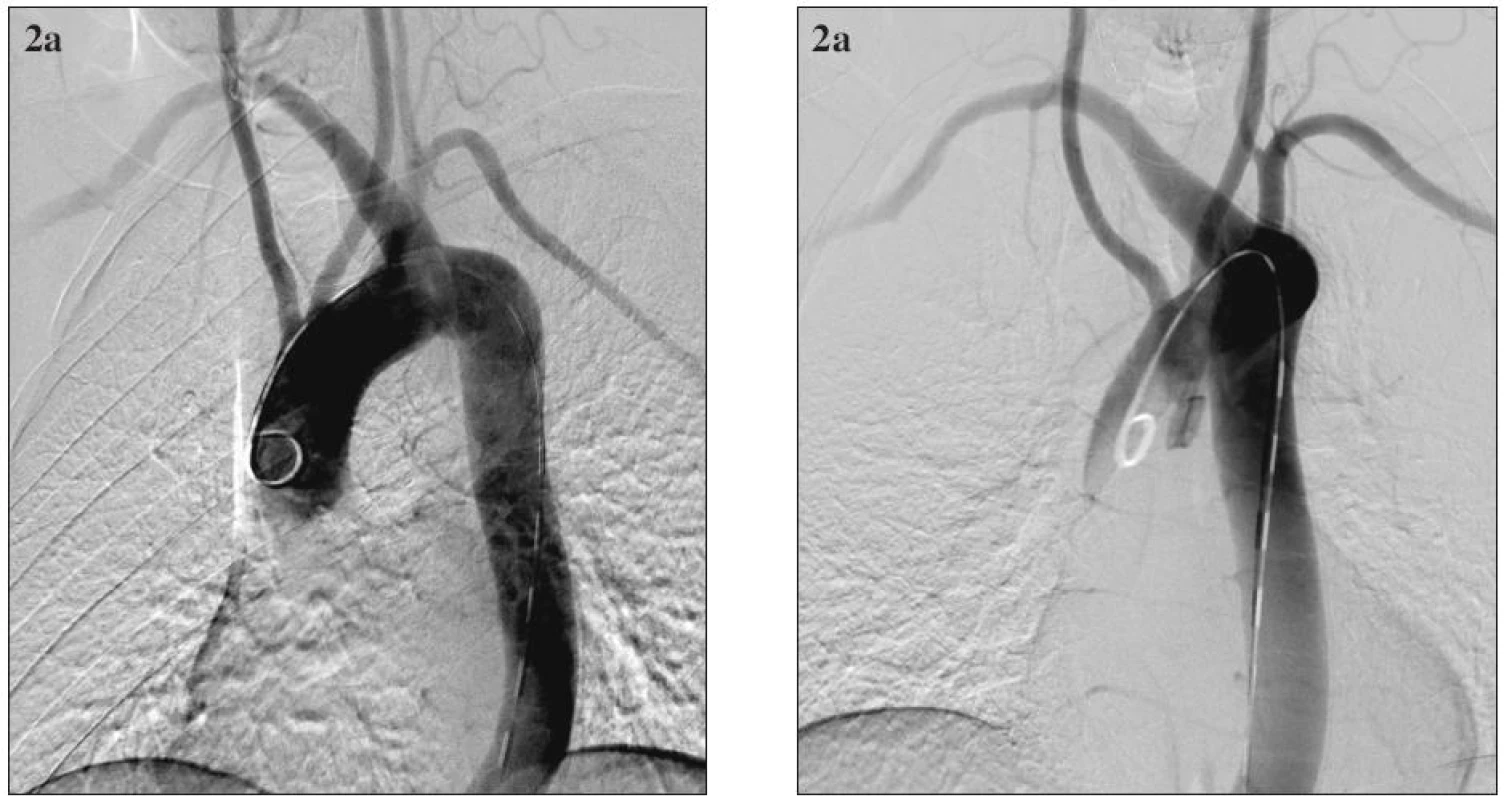 54-ročný muž s aneuryzmatickou dilatáciou anomálne odstupujúcej arteria subclavia dextra (arteria lusoria) a aneuryzmou Kommerellovho divertikla. Digitálna subtrakčná angiografia aortálneho oblúka a supraaortových vetiev. Obr. 2a. predozadná projekcia; Obr. 2b. šikmá projekcia.
Fig. 2. A 54- year old male with aneurysmal dilatation of an abnormal arteria subclavia dextra (arteria lusoria) and with the Kommerell diverticle aneurysm. Digital subtraction angiography of the aortic arch and supraaortic branches. Fig. 2a. A-P view; Fig. 2b. oblique view. 