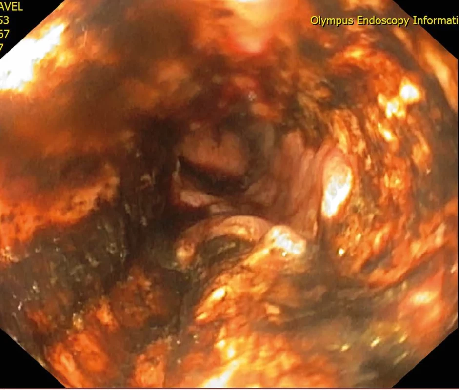 Gastroskopie, esophagitis Fig. 2: Gastroscopy, esophagitis