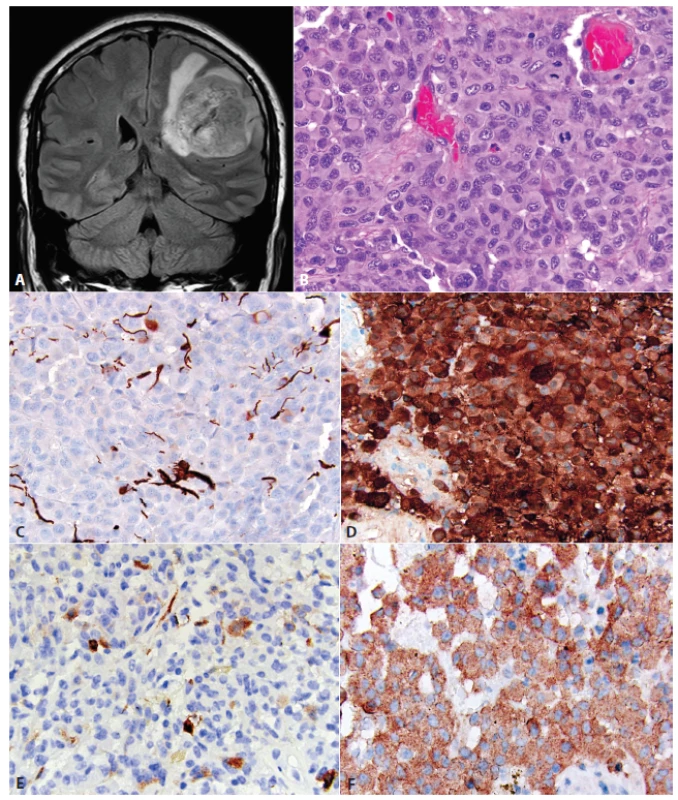 Epitelioidný glioblastóm (eGBM). MRI tumoru pravej frontoparietálnej oblasti u 21 ročnej ženy <b>(A)</b>. Nádor bol tvorený monotónnou populáciou epiteloidných buniek s objemnou eozinofilnou cytoplazmou. Niektoré bunky mali rabdoidnú morfológiu, s excentricky uloženými jadrami a eozinofilnou cytoplazmatickou inklúziou (šípka, <b>B</b>). Expresia GFAP v eGBM je často limitovaná na malú časť buniek, alebo môže byť kompletne negatívna <b>(C</b>). Difúzna expresia S100 proteínu (alternatívny „gliálny“ marker). Ostatné melanoma-markery sú vždy negatívne <b>(D)</b>. Častá je fokálna expresia „neuronálnych“ markerov, napr. neurofilamet proteínu <b>(E)</b>. Difúzna expresia BRAF V600E mutovaného proteínu <b>(F)</b>. Obrázky láskavo poskytol Arie Perry, Department of Pathology, Division of Neuropathology, University of California, San Francisco, USA.