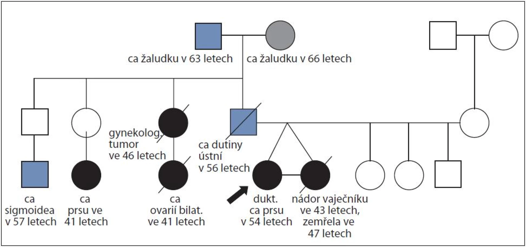 Rodina ženy s duktálním karcinomem prsu v 54 letech a její monozygotní sestra s nádorem vaječníků ve 43 letech; časový interval sledování 11 let; nalezena familiární mutace c.213-12A>G v genu <i>BRCA1</i>.