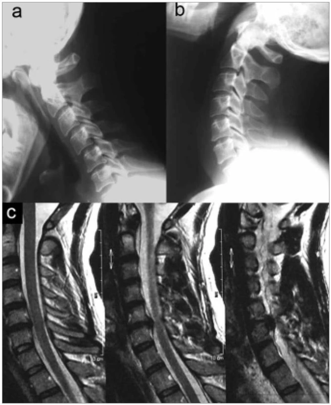 Vyšetření nutná pro indikaci CTDR: ideální kandidát. Dynamické laterogramy prokazují dostatečnou výšku a pohyb prostoru C5/6. Na zobrazení magnetickou rezonancí je dokumentován měkký výhřez disku C5/6.