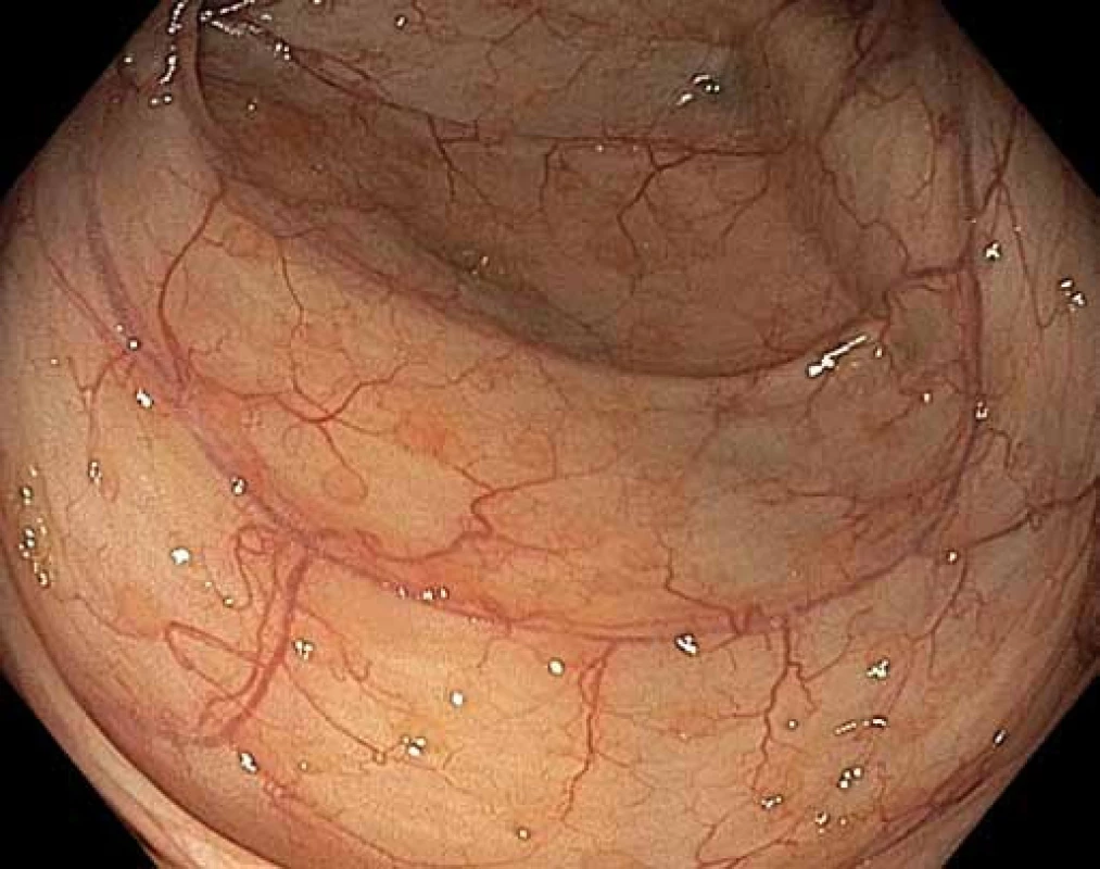 Normální tračník, slizniční lymfatické folikuly v bílém světle (drobná okrouhlá mírně prominující ložiska).
Fig. 5. Normal colon, mucosal lymphatic follicles in white light (small circular slightly protruding spots).