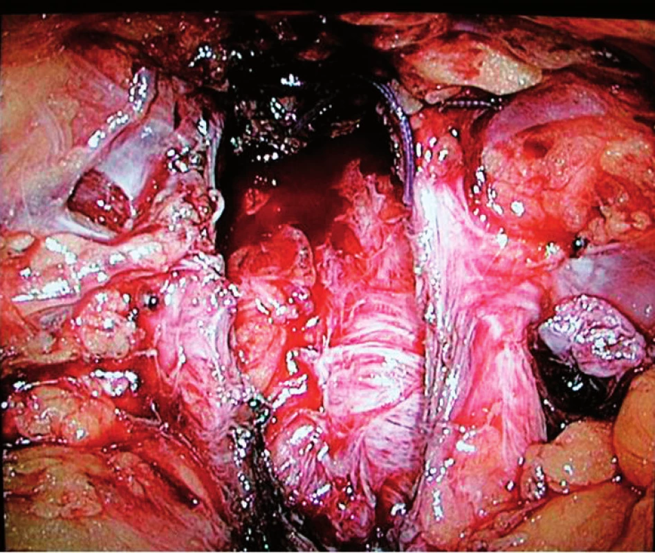 Lůžko po intrafasciální EERP
Fig. 1. Prostatic bed after intrafascial EERP