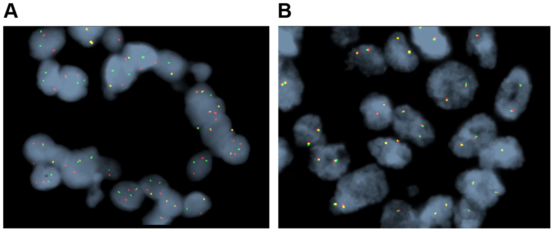 Representative fluorescent <i>in situ</i> hybridization (FISH) demonstrating the presence of FGFR2 fusion.
