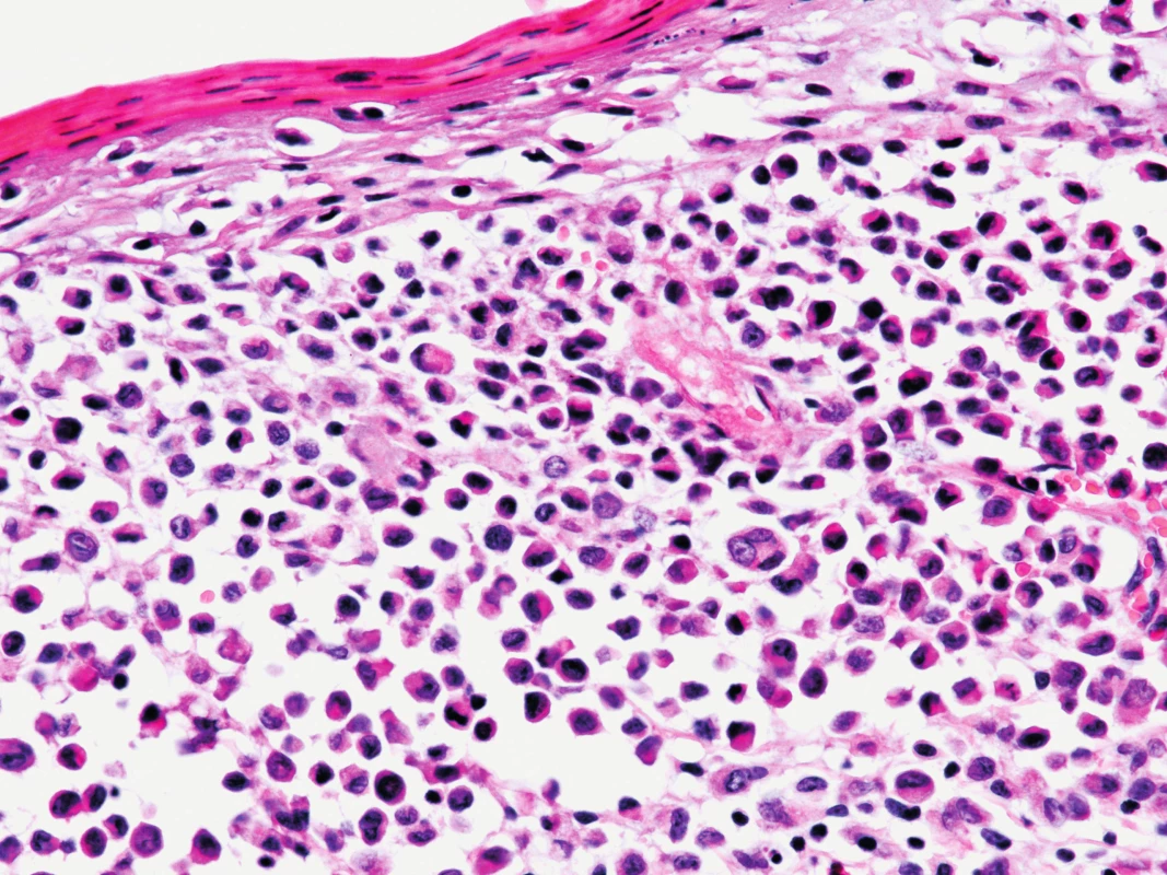 Kožní biopsie při barvení hematoxylin-eosinem, 400x zvětšeno, detail na nádorové elementy: eozinofilní cytoplazma, ledvinovité jádro, vícejaderné elementy, příměs eozinofilů při spodině.
Fig. 5. The skin biopsy, hematoxylin eosin staining, 400x enlargement, a detail of tumorous elements: eosinophilic cytoplasm, kidney-shape nucleus, multinucleus elements, eosinophils in the buttom.