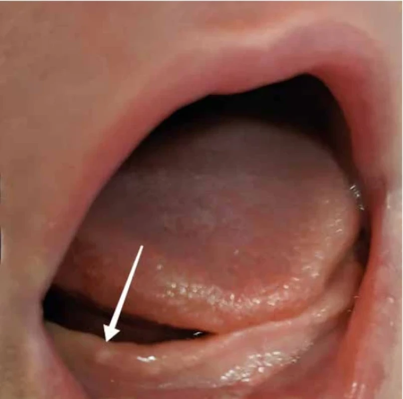 Cysta z lamina dentalis