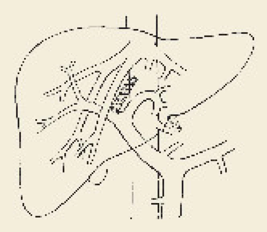 Schéma přímé (direct) intrahepatální portosystémové spojky (DIPS).
Fig. 2. Diagram of direct intrahepatic portosystemic shunt (DIPS).