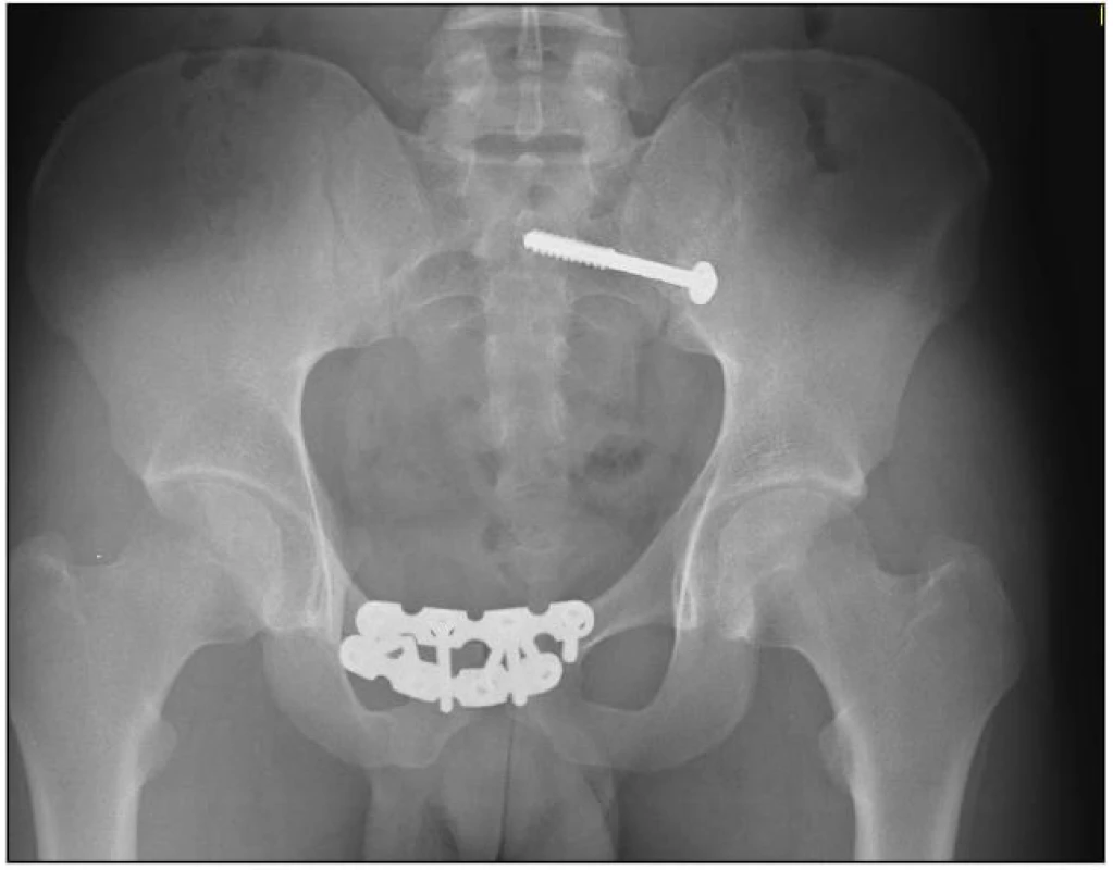 Kombinace dlahové osteosyntézy předního segmentu pomocí dvou rekonstrukčních dlah a kompresního ileoskrálního šroubu u poranění pánve typu C1