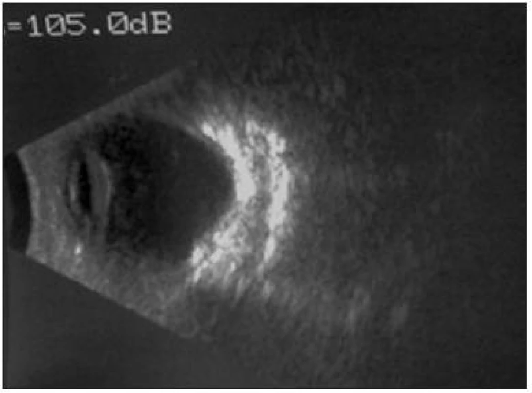 Aplázia zrakového nervu Mikroftalmia, B scan, pravé oko