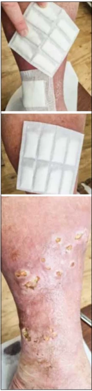 Mnohočetné ulcerace na bérci po erysipelu.