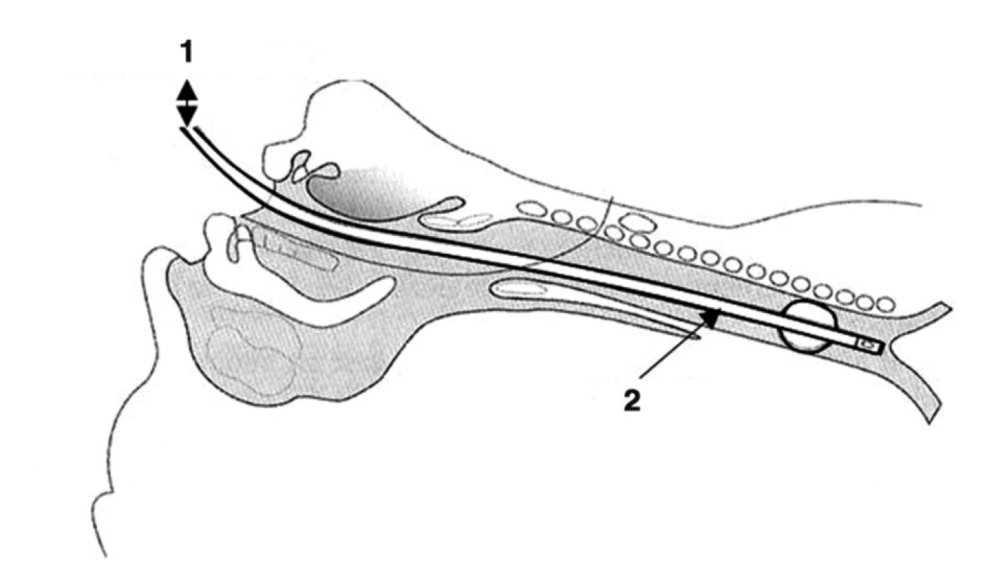 Schematické znázornenie zavedenej „úzkej“ originálnej endotracheálnej kanyly pri „Fantoniho tracheotómii“
1 – Ventilátor konvenčný
2 – ET kanyla s balónom, ID/ED = 5/7–8 mm