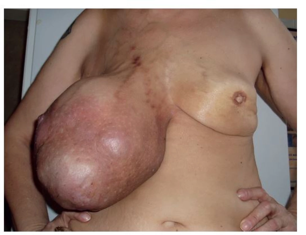 <b>Maligní fyloidní tumor</b>
Významnější celularita a jaderná polymorfie. Hematoxylin-eosin, zvětšení 100x.
<b>Fig. 2: Malignant phyllodes tumour</b>
More significant cellularity and nucleus polymorphy. Hematoxylin- eosin, magnified 100x.