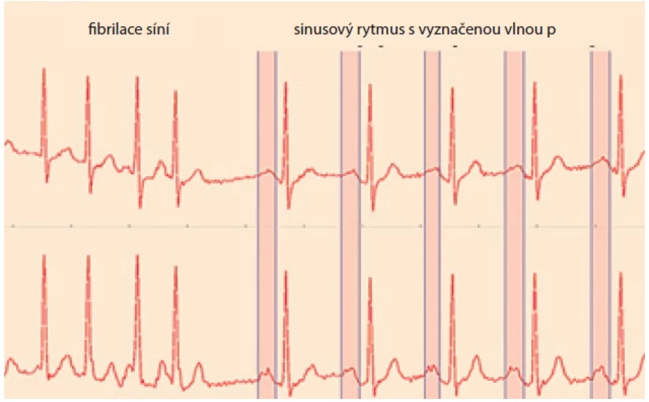 EKG záznam fi brilace síní s přechodem na sinusový rytmus. Fig. 1. ECG of atrial fi brillation transversion to sinus rhythm.