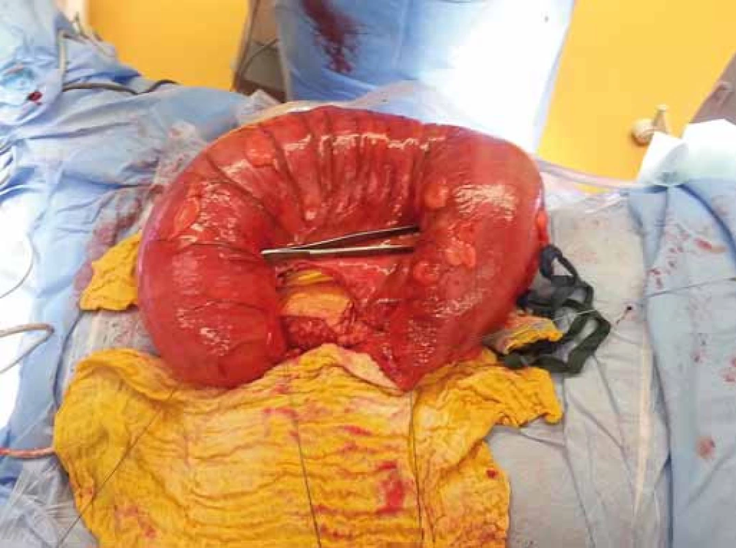 Resekát dolichosigmatu.
Fig. 4. Surgical specimen of sigmoid colon.