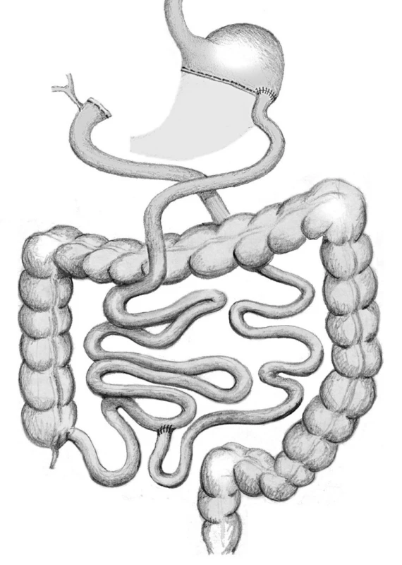Biliopancreatická diverze typu Scopinaro
Fig. 5: Biliopancreatic diversion – Scopinaro
