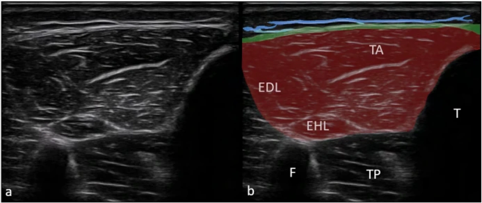 Zobrazení fascia cruris v lokalizaci anterior na nativním sonografickém snímku (a) a na barevně zvýrazněném sonografickém snímku (b). Superficiální fascie je znázorněna modrou linií. Hluboká fascie (zelená linie) přechází přes m. tibialis anterior (TA). Uvnitř bříška TA musí být také zobrazena diagonální hyperechogenní linie znázorňující šlachu. Retinacula cutis profundus jsou znázorněna světle modrou barvou.  Fig. 8. Imaging of the crural fascia in the anterior location in the original ultrasound image (a) and in a color-enhanced ultrasound image (b). The superficial fascia is represented by a blue line. The deep fascia is represented by a green line over the tibialis anterior muscle (TA). Retinacula cutis profundus are shown in light blue. Tendinous landmark must also be present within the tibialis anterior muscle. 