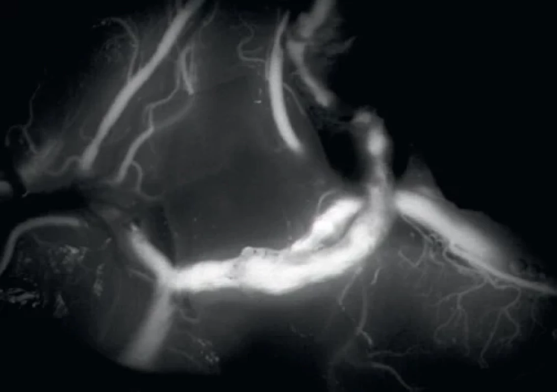 Peroperační indocyaninová fluorescenční videoangiografie (ICG) patentního bypassu.