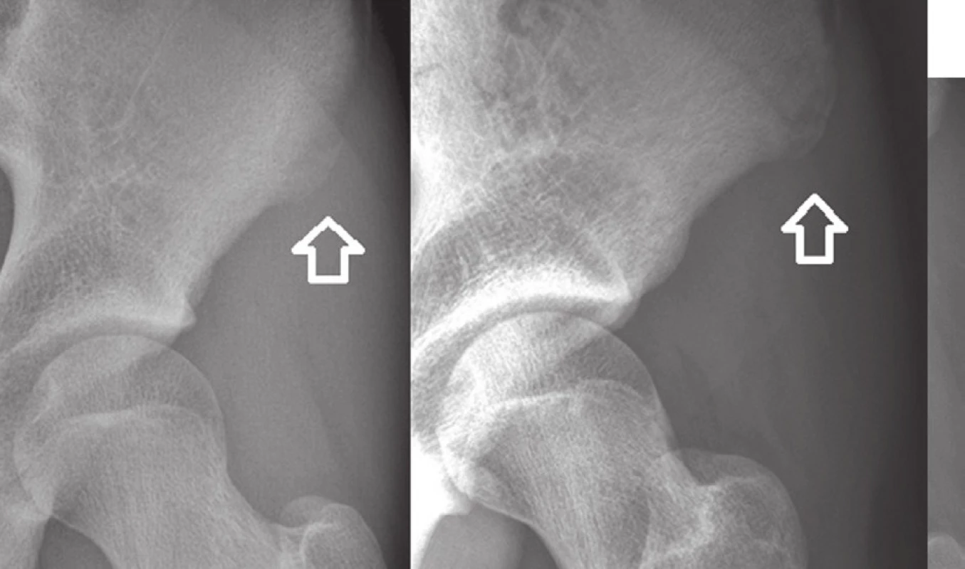 a – Avulzní zlomenina spina iliaca anterior superior s minimální dislokací, úrazový snímek, b – stejný pacient se zhojenou zlomeninou
Fig. 2: a – Avulsion fracture of the anterior superior iliac spine with minimal dislocation; X-ray at the time of injury; b – the same patient with the fracture healed