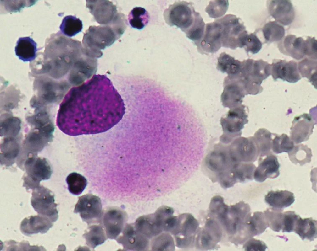 Hypolobulární megakaryocyt u 5q minus syndromu.