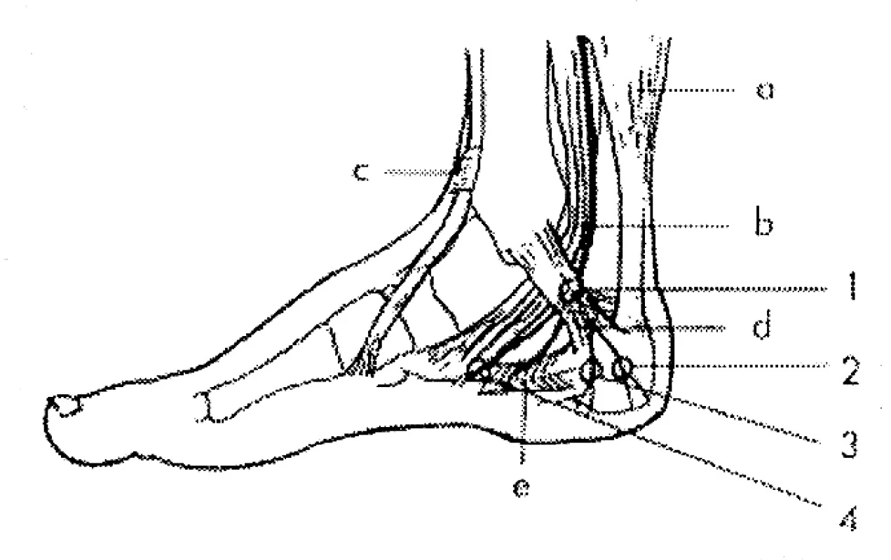 Syndrom mediální tarzálního tunelu
Úžiny:
1 – mediální tarzální tunel,
2 a 3 – rr. calcaneares,
4 – n. plantaris medialis.
Svaly:
a – m. triceps surae,
b – šlacha m. tibialis posterior,
c – šlacha m. tibialis anterior,
d – ligamentum lanciniatum,