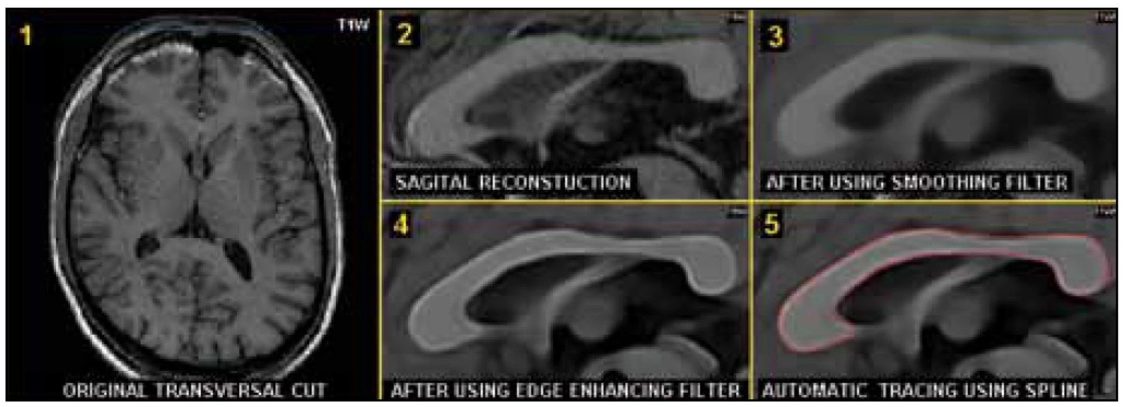 Plně automatické měření plochy corpus callosum na středovém řezu, sagitální rekonstrukce (T1W/3D). Výchozí transverzální řez (1), sagitální rekonstrukce (2), vyhlazení (3), zvýraznění okrajů corpus callosum (4), vlastní automatické obtažení (5).
