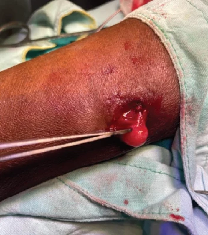 Schwannoma rising from the left side lateral antebrachial cutaneous nerve, which was excised with preservation of the nerve fascicle.