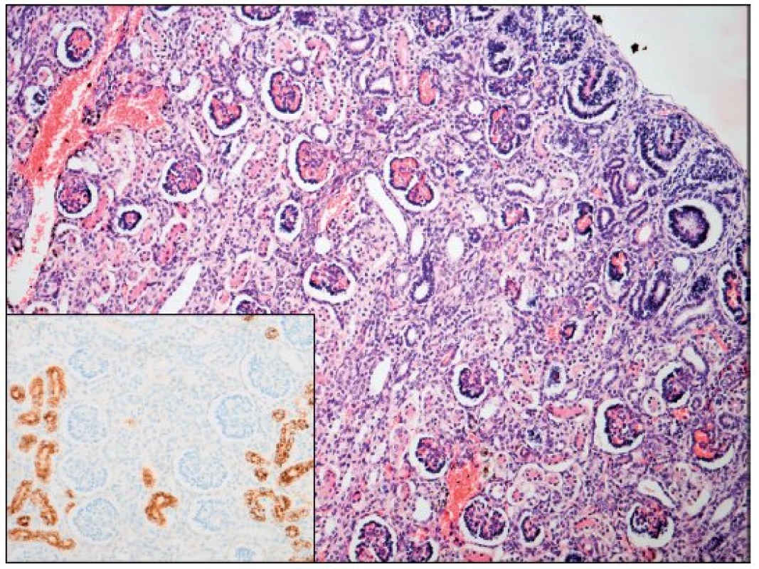 Ledvina – renální tubulární dysgeneze (hematoxylin - eosin; AMACR; zvětšení 100; počet proximálních tubulů 18/mm<sup>2</sup>).
Fig. 1. Kidney – renal tubular dysgenesis (hematoxylineeosine and AMACR; magnification 100; proximal tubules count 18 per mm<sup>2</sup>).