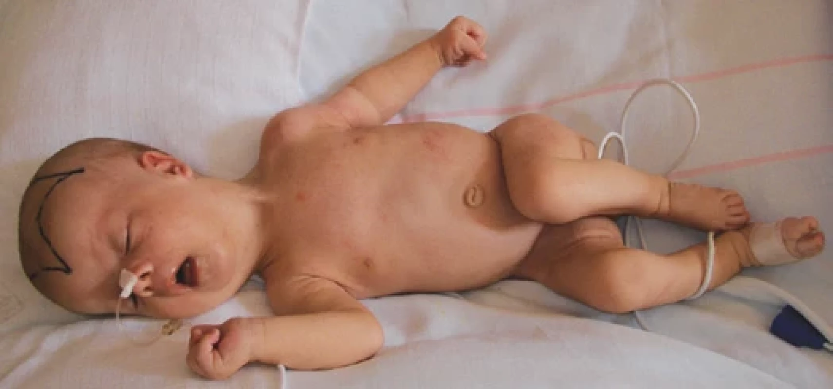 Kojenec se Zellwegerovým syndromem. Nápadná je kraniofaciální dysmorfie s vysokým čelem, dolichocefalie, široce zející velká fontanela a těžká hypotonie („floppy infant“).