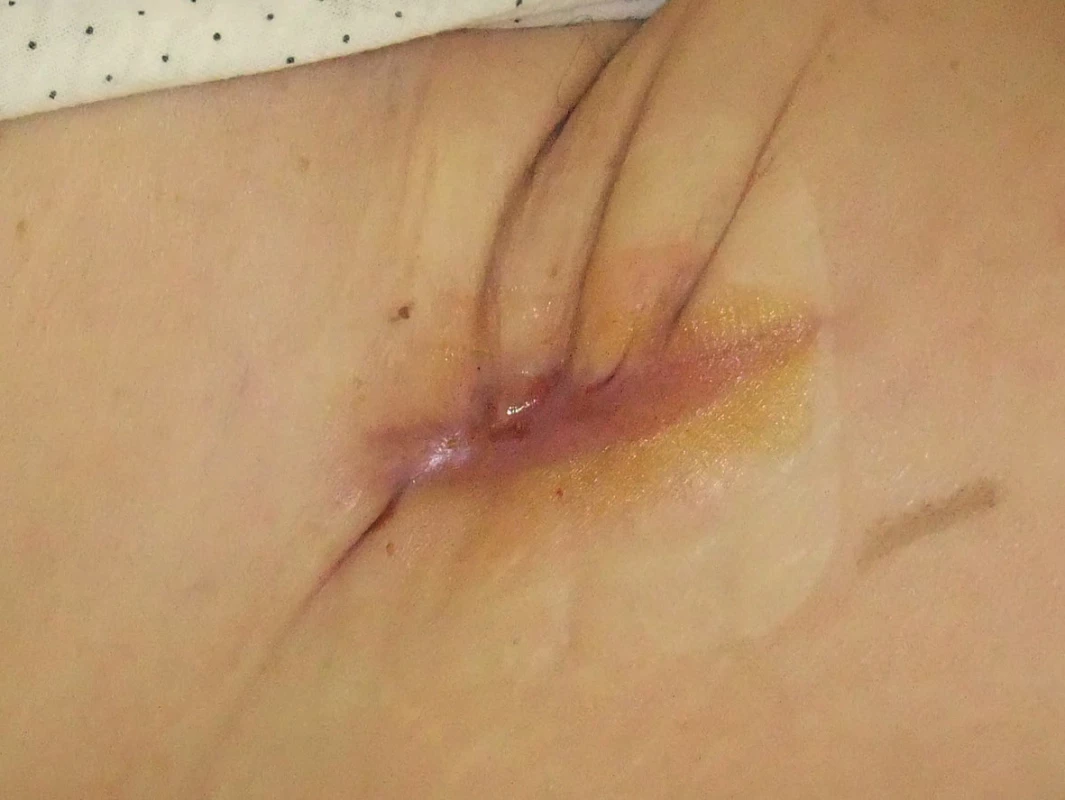 Tatáž pacientka po 16 dnech podtlakové terapie a dohojení rány v pravém třísle preparáty vlhkého hojení, ambulantní kontrola
Fig. 2: The same patient after 16 days of negative pressure wound therapy and moist wound healing; complete wound closure. Outpatient follow-up