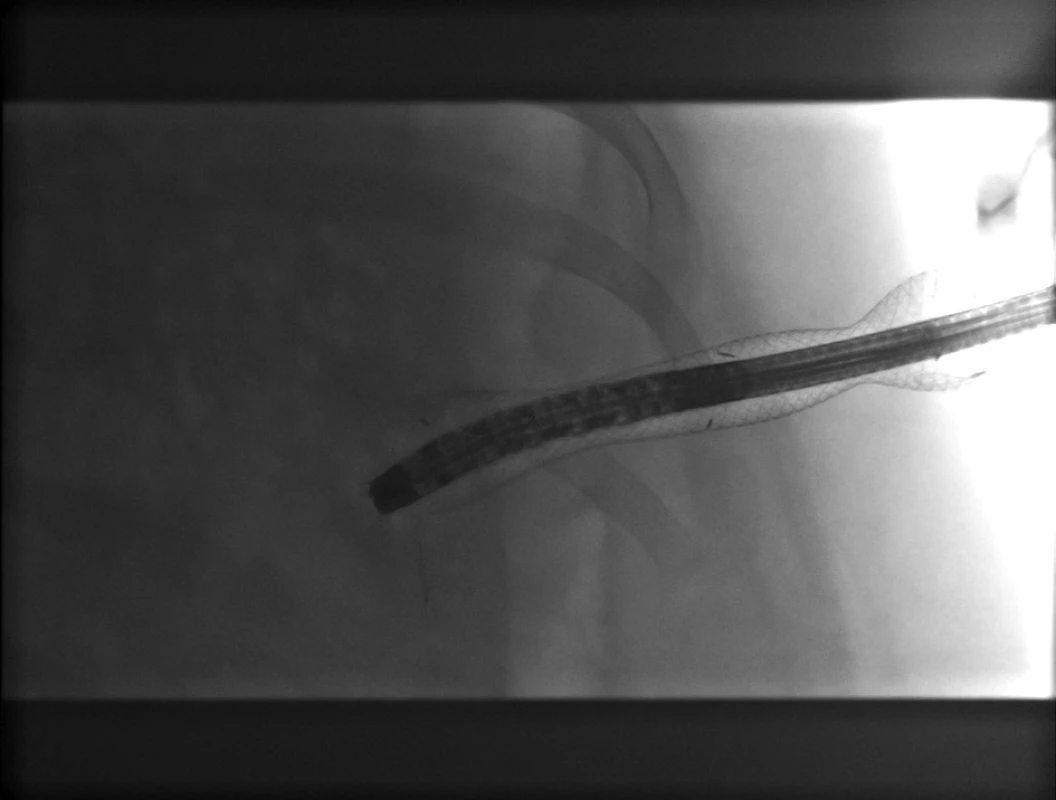 Perkutánní endoskopická nekrektomie – RTG obraz
Fig. 3: Percutaneous endoscopic necrectomy - X-ray finding
