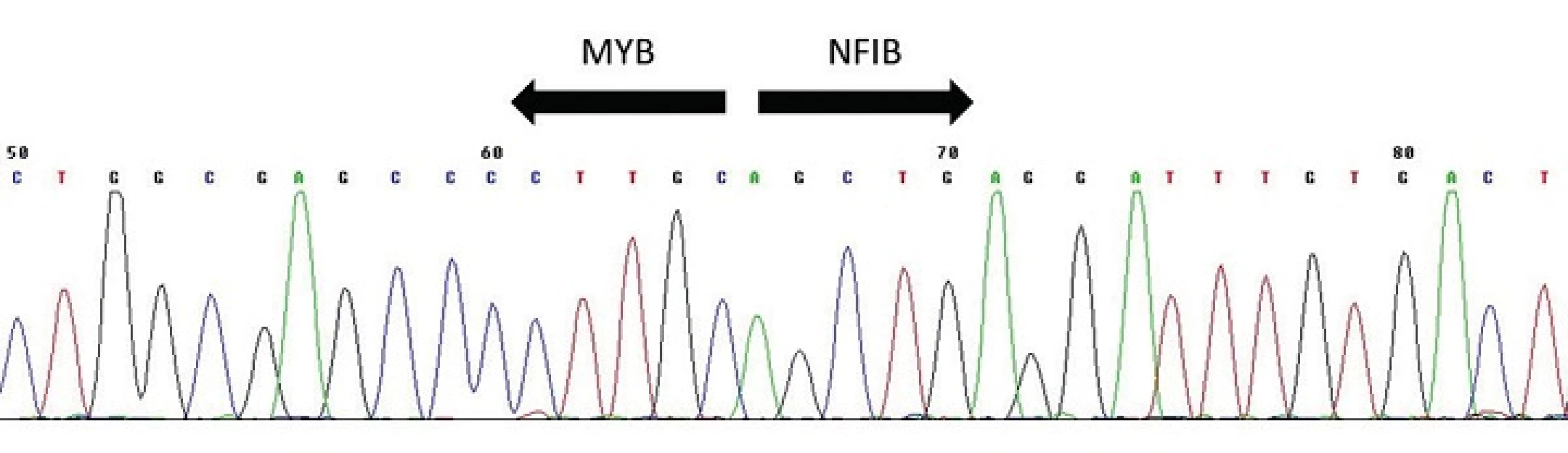 Sekvenogram fúzního transkriptu <i>MYB-NFIB</i>. Šipky vyznačují místo fúze.