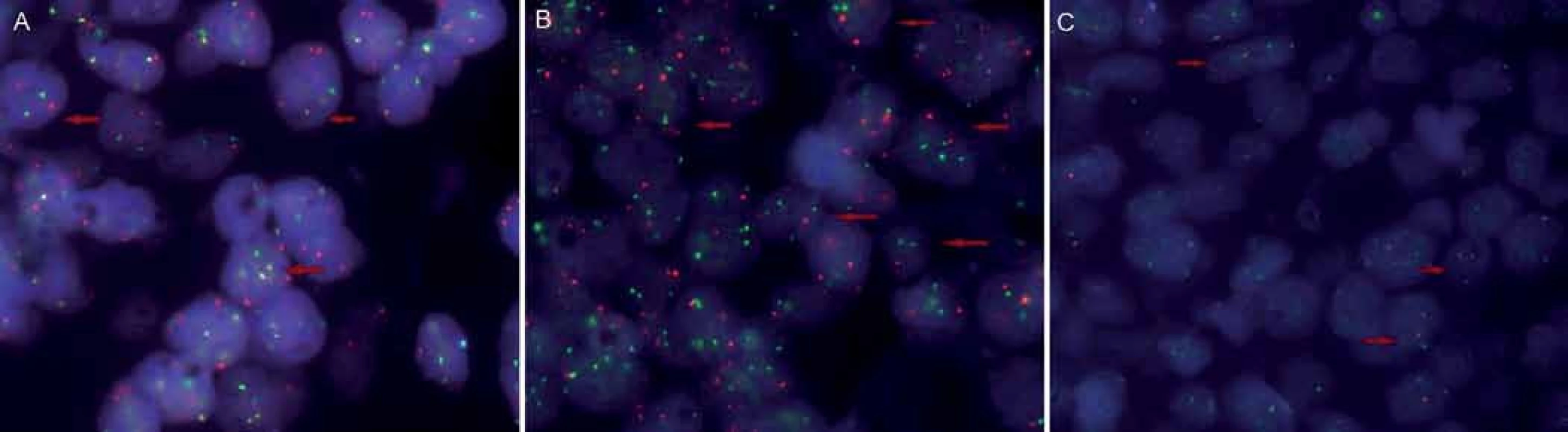 Fluorescenční hybridizace <em>in situ</em>. Translokace t(14;18) byla detekována využitím dvoubarevné fúzní sondy <em>IGH/BCL2</em> v 77 % vyšetřených buněčných jader (A); translokace t(8;14) byla pomocí fúzní sondy <em>IGH/MYC</em> nalezena jen u 1 % jader; přestavba genu <em>MYC</em> – lokusu 8q24 – byla detekována využitím zlomové sondy ve 28 % jader (C).