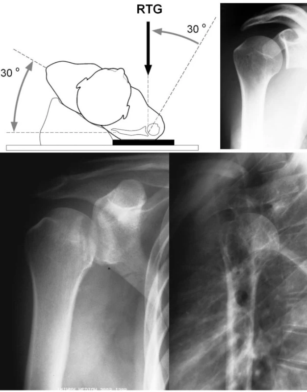 RTG diagnostika: a) správně provedený RTG snímek ramene, b) nález zadní luxace ramene na RTG (AP a transtorakální snímek)
Pic. 1. X-ray: a) a correct shoulder x-ray view, b) x-ray findings of posterior dislocation of the shoulder (AP and transthoracic views)