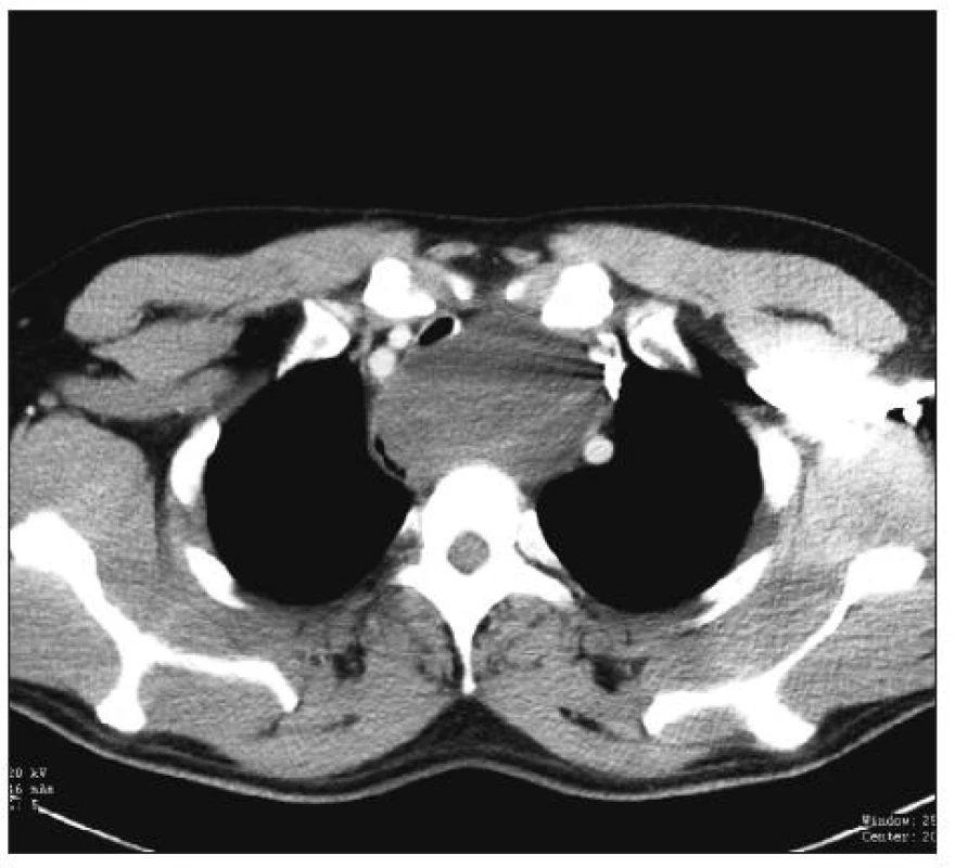 CT obraz – bronchiální cysta horního mediastina, muž 36 let, operace: krční mediastinotomie/parc. sternotomie
Fig. 3. CT view – bronchial cyst in upper mediastinum, 36-year old male, procedure: cervical mediastinotomy/partial sternotomy