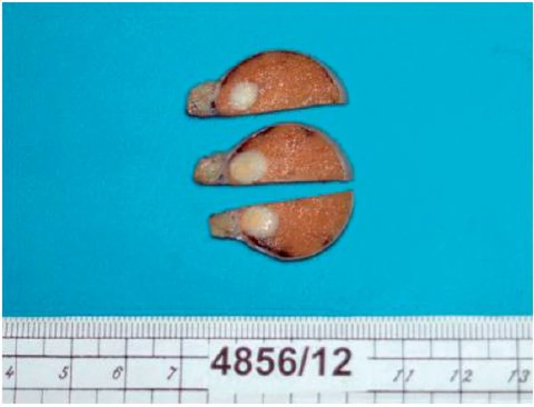 varletem s patrným intraparenchymovým nádorem
Fig. 2. Crossection of the testis with intraparenchymal tumor