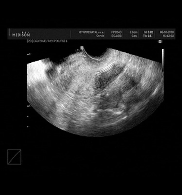 IUDs posunuté kaudálně v dutině děložní