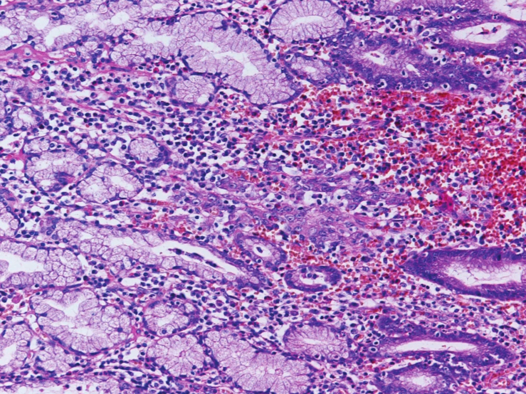 Skupina karcinomových buněk (uprostřed) ve sliznici žaludeční Originální zvětšení 200x, HE (hematoxylin, eosin).
Fig. 2: Group of cancer cells (in the middle) in gastric mucosa Original magnification 200x, HE (haematoxylin, eosin