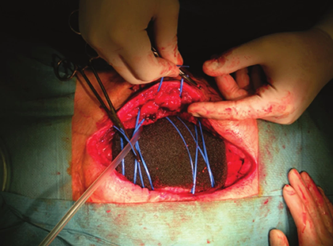 Dynamická sutura stěny břišní
Fig. 3: Dynamic abdominal wall suture