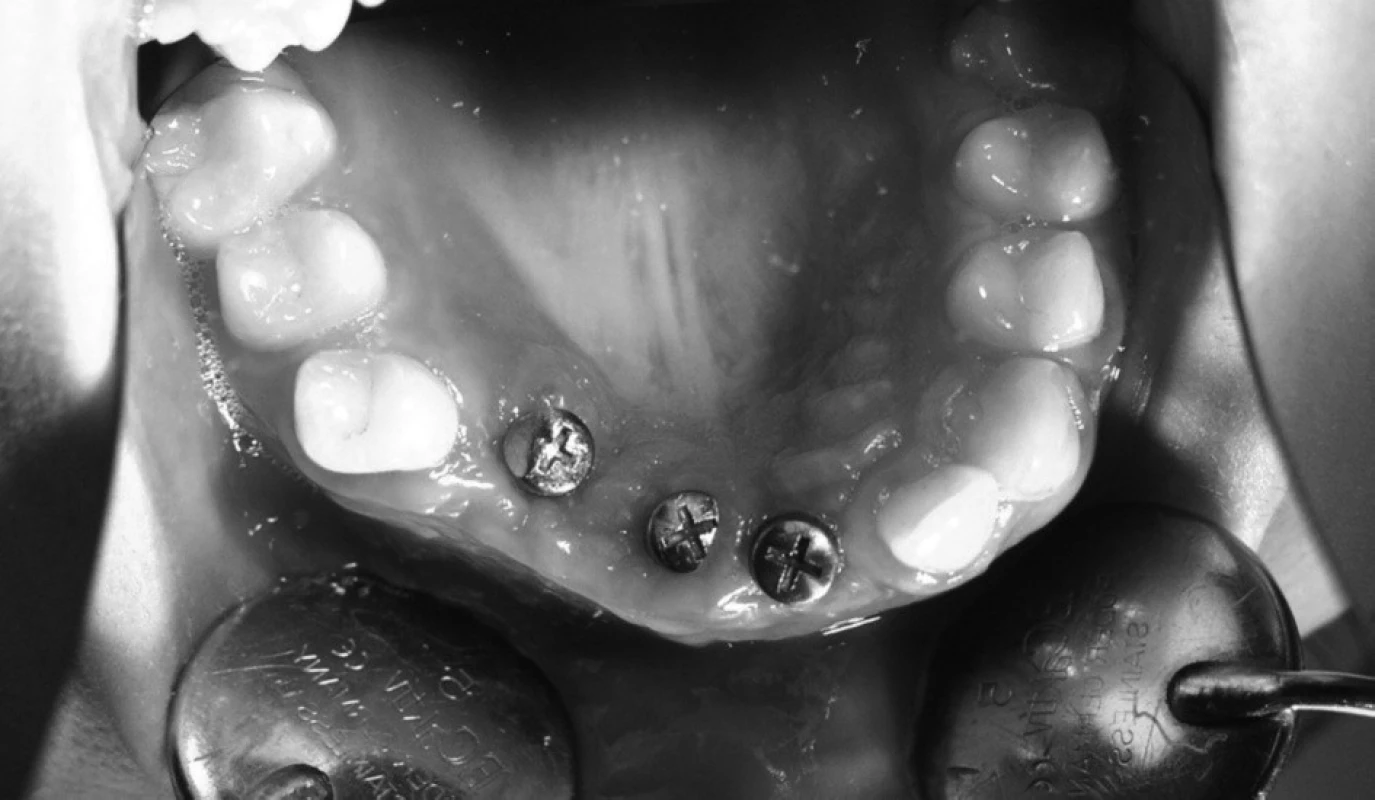 Stav po osteointegraci a zavedení vhojovacích válečků. Zřetelná je nevýhodná palatinální pozice implantátů reg. 13 a 11.