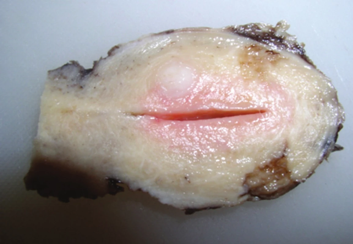 Děloha na řezu, s úzkou dutinou, nad ní myom, patrné okrsky průniku zánětlivé infiltrace do myometria 
Fig. 5: A section through the uterus with a narrow cavity, the myoma above, noticeable penetration districts of inflammatory infiltration into the myometrium
