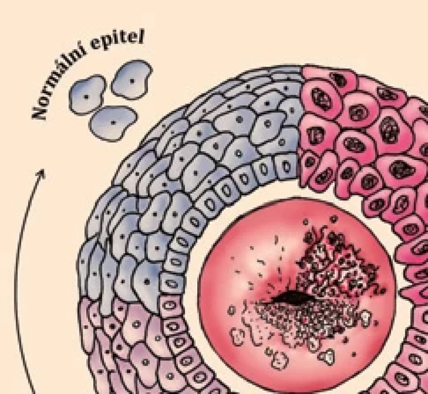Kolposkopické (vnitřní část obrázku), histopatologické (vnější část obrázku) a cytologické (jednotlivé buňky na okrajích) změny v souvislosti s HPV infekcí děložního čípku.