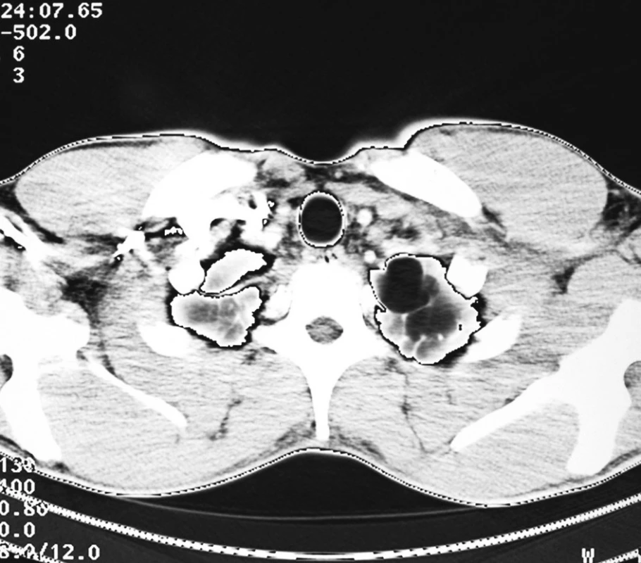 CT scan – emfyzematózní buly v apexu levé plíce
Fig. 1. CT scan – emphysematous bullae in the left pulmonary apex 
