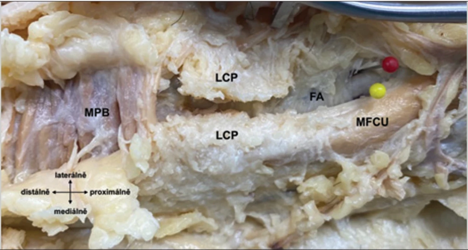 Strop canalis ulnaris tvoří proximodistálně: distální část fascia antebrachii, „ligamentum carpi palmare“ (protnuté) a musculus  palmaris brevis. Nervus ulnaris je označen žlutou značkou a vasa ulnaria červenou.  Fig. 10. Roof of the ulnar canal is formed proximodistally by the distal part of the fascia antebrachii, the “ligamentum carpi palmare”  (severed), and the musculus palmaris brevis. Nervus ulnaris is marked in yellow, and vasa ulnaria in red.