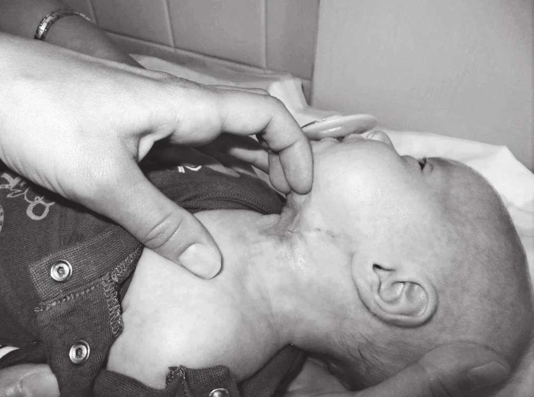 Pooperační hojení rány.
Fig. 4. Wound healing.