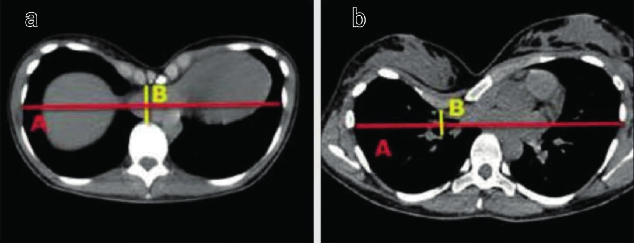Hodnotenie Hallerovho indexu (HI= A/B)
a) Meranie HI u pacienta so symetrickou deformitou
b) Meranie HI u pacienta s asymetrickou deformitou
Fig. 3: Haller index evaluation (HI= A/B)
a) Patient with symmetric deformity
b) Patient with asymmetric deformity