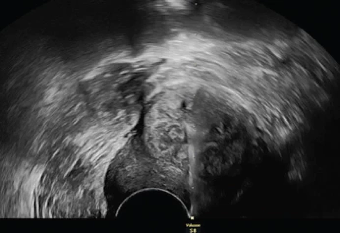 Ultrazvukem navigovaná transcervikální tru-cut biopsie – jehla viditelná kompletně uvnitř myometrální léze.