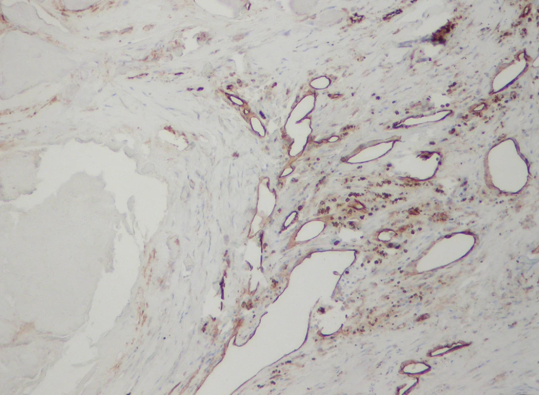 CD31+ thin-walled blood vessels in the vicinity of a calcified nodule