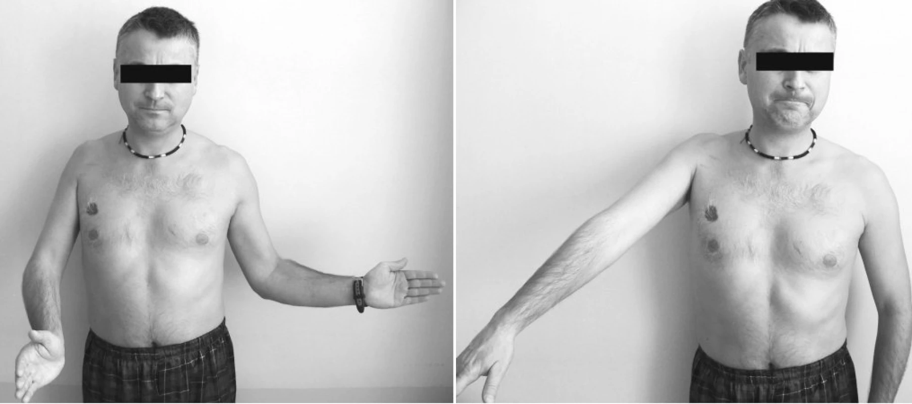 Typický klinický nález zadní luxace vpravo – a) omezení zevní rotace, b) omezení abdukce ramene
Pic. 2. A typical clinical finding of posterior dislocation of the right shoulder – a) reduced external rotation, b) reduced abduction of the shoulder