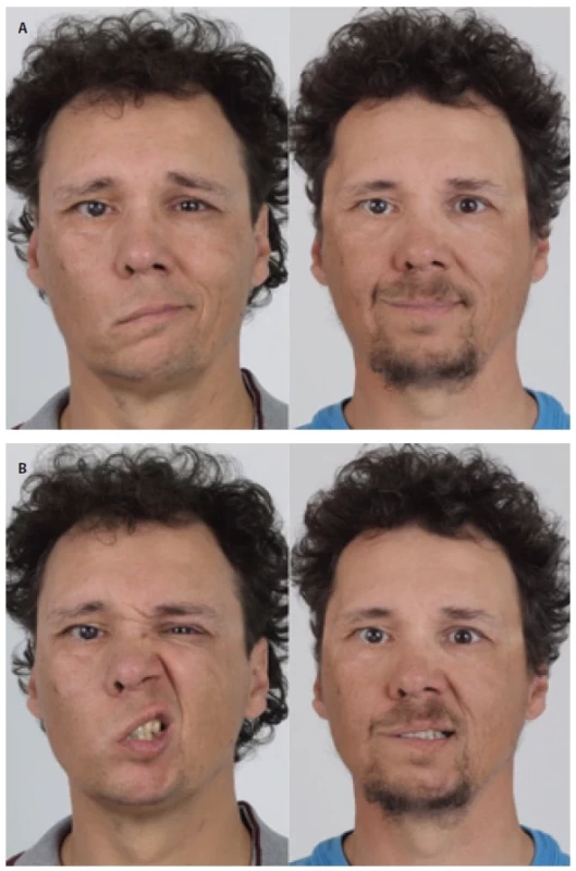 Representative pre- and post-operative clinical photographs of a patient undergoing lengthening temporalis myoplasty procedure. Frontal views demonstrating facial symmetry and improvement in the position of the nasolabial fold after the procedure: A) closed-mouth smile before and after surgery; B) open-mouth smile before and after surgery.